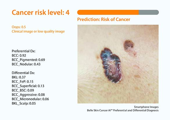 skin-cancer-1