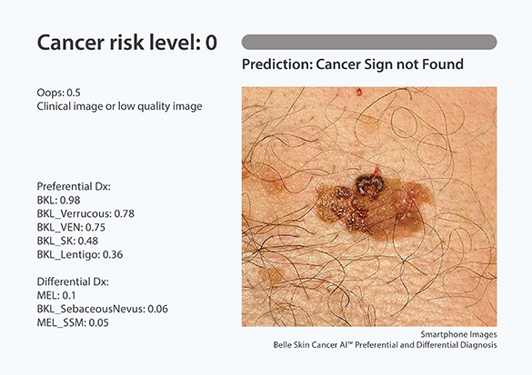 skin-cancer-2