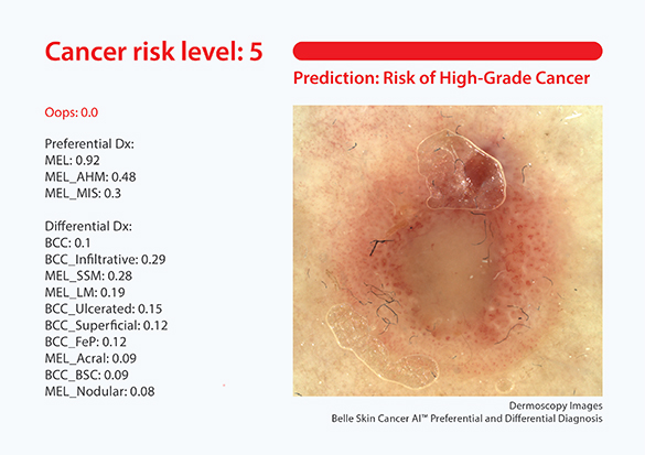 skin-cancer-3